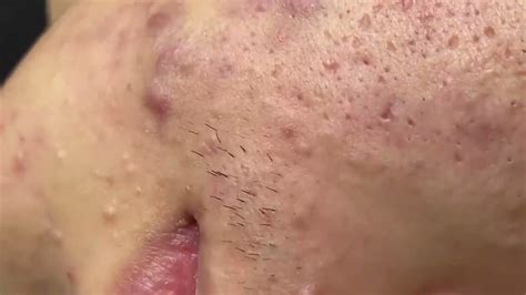 Worst of the worst gigantic blackheads, new cyst removal videos, newest cyst popping videos, new spa blackheads removal, biggest blackheads ever, biggest cyst ever. . Blackheads 2022 new videos sac dep spa